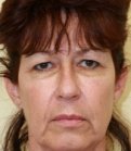 Browlift Case 5 - before