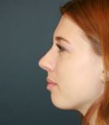 Nose Surgery San Diego 184 - after