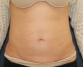 TummyTuck LA - before