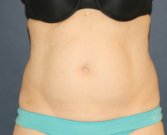 Tummy-Tuck-Scar - before