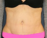 Tummy-Tuck-Scar - after