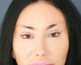 Bratz Blepharoplasty - after