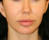 Lip Filler Lip Lift - before
