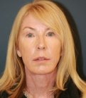 Laser Face Lift - after