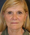 Laser with Neck Lift - before