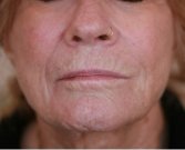 Lip Wrinkles Smoothing - before