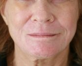 Lip Wrinkles Smoothing - after