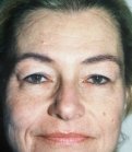 Browlift  Case 8 - before