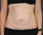 Texas Tummy Tuck - before
