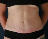 Texas Tummy Tuck - after