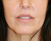 Corner and Lip Lift - after