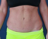 Best Tummy Tuck 38 - after