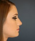 Rhinoplasty 220 - before