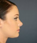 Rhinoplasty 220 - after