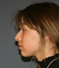 Rhinoplasty 221 - before
