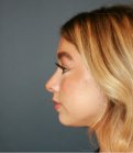Rhinoplasty 221 - after