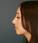 Rhinoplasty 222 - after