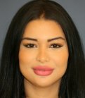 Rhinoplasty 223 - before