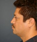 Rhinoplasty 224 - before