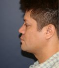 Rhinoplasty 224 - after
