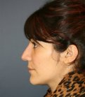 Rhinoplasty 225 - before