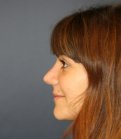 Rhinoplasty 225 - after