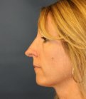 Rhinoplasty 226 - before