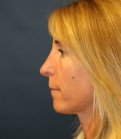 Rhinoplasty 226 - after