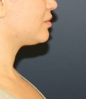 Neck Lipo San Diego - before