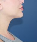 Neck Lipo San Diego - after