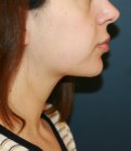 Lipo Neck and Face - after