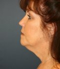 Necklift and Lips - before