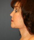 Necklift and Lips - after