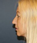 Rhinoplasty SD 227 - before