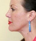 Liposuction of Neck - after