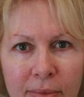 Eyelids 114 - before