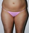 Liposuction Case 2 - before