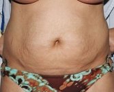 Tummy Tuck Case 11 - before
