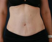 Tummy Tuck with Hernia Repair - after