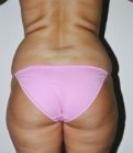 Liposuction Case 9 - before