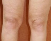 Liposuction Case 7 - before