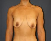 Weight Loss Breast Lift - before