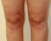 Liposuction Case 7 - after