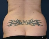Liposuction Muffin Top - before