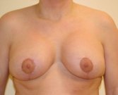 Breast Lift 266 - after