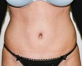 Tummy Tuck Case 11 - after