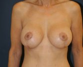 Breast Lift with Implants 70 - after