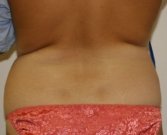 Liposuction of Waist and Flanks - before