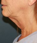 Sagging Neck Lift - before