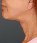Sagging Neck Lift - after